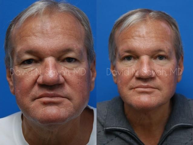 Facelift Before and After | Sayah Institute