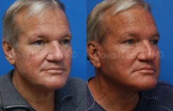 Facelift Before and After | Sayah Institute