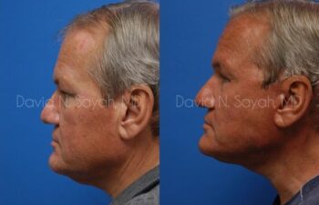 Facelift Before and After | Sayah Institute