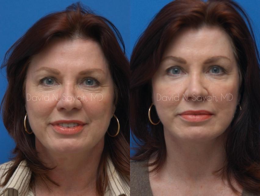 Facelift Before and After | Sayah Institute
