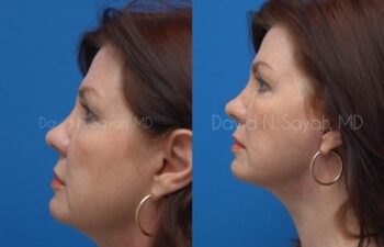 Facelift Before and After | Sayah Institute