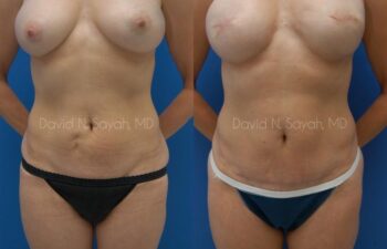 Mini Tummy Tuck Before and After | Sayah Institute