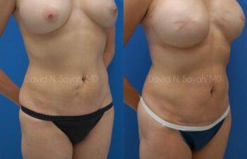 Mini Tummy Tuck Before and After | Sayah Institute