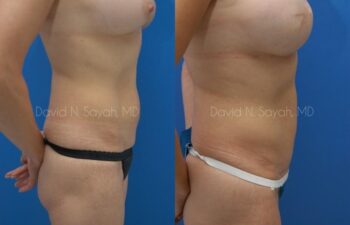 Mini Tummy Tuck Before and After | Sayah Institute