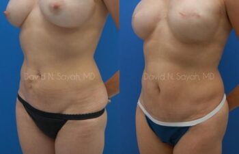 Mini Tummy Tuck Before and After | Sayah Institute