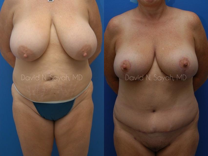 Mommy Makeover Before and After | Sayah Institute