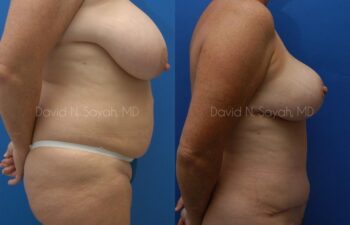 Mommy Makeover Before and After | Sayah Institute