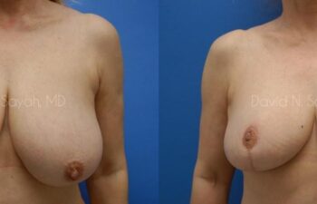 Breast Reduction Before and After | Sayah Institute