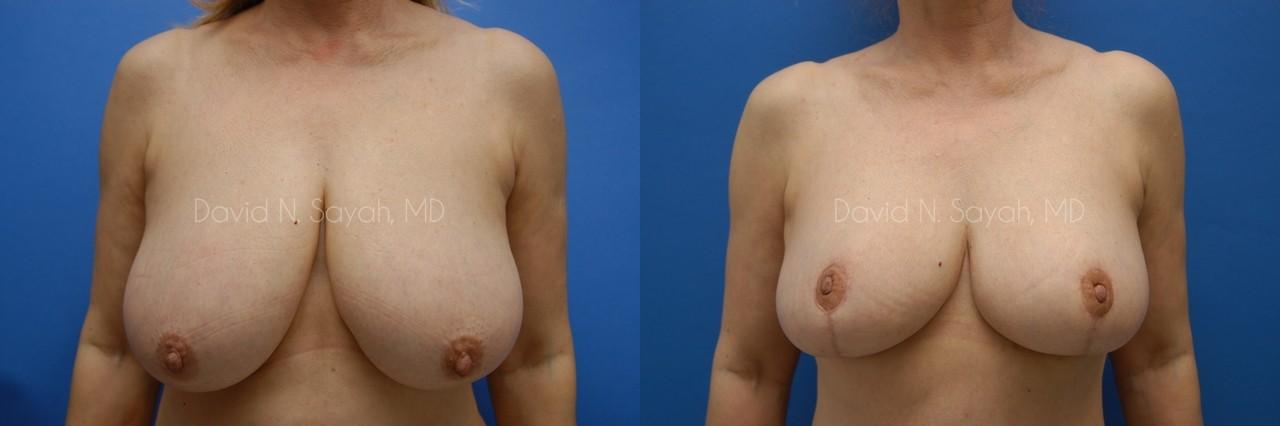 Breast Reduction Before and After | Sayah Institute