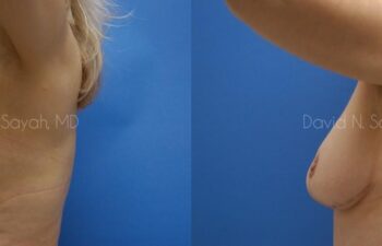 Breast Reduction Before and After | Sayah Institute