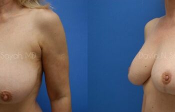 Breast Reduction Before and After | Sayah Institute