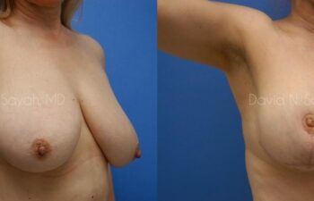 Breast Reduction Before and After | Sayah Institute