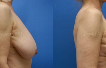Breast Reduction Before and After | Sayah Institute