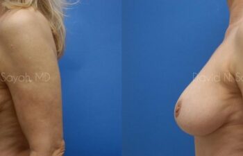 Breast Reduction Before and After | Sayah Institute