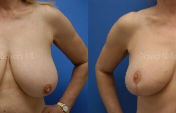 Breast Reduction Before and After | Sayah Institute