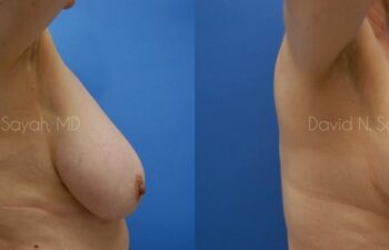 Breast Reduction Before and After | Sayah Institute