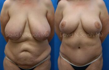 Breast Lift Before and After | Sayah Institute