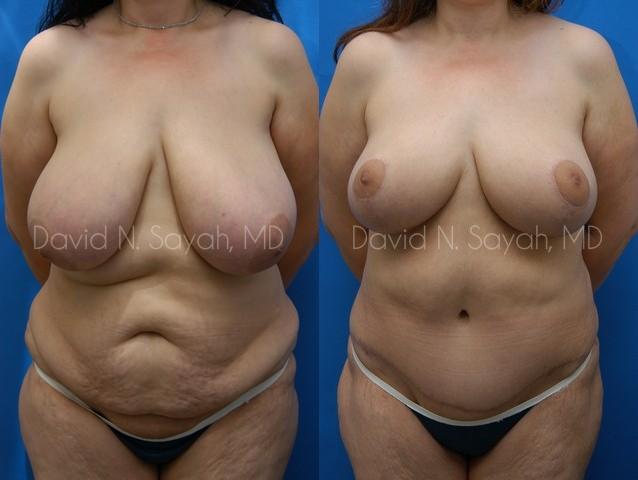 Breast Lift Before and After | Sayah Institute