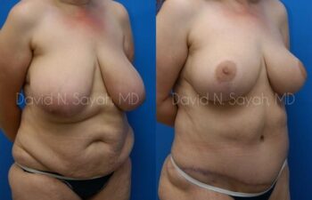 Breast Lift Before and After | Sayah Institute