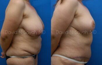Breast Lift Before and After | Sayah Institute