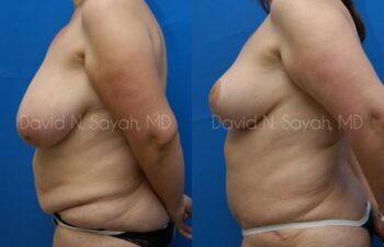 Breast Lift Before and After | Sayah Institute