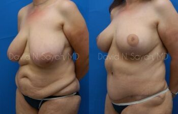 Breast Lift Before and After | Sayah Institute