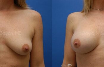 Mommy Makeover Before and After | Sayah Institute