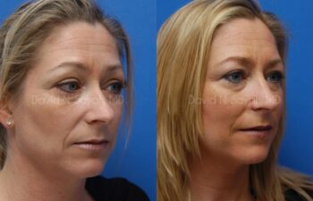 Mommy Makeover Before and After | Sayah Institute