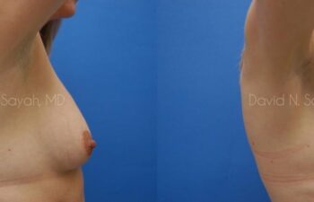 Mommy Makeover Before and After | Sayah Institute