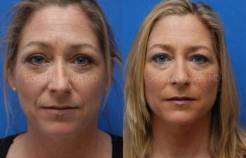 Mommy Makeover Before and After | Sayah Institute