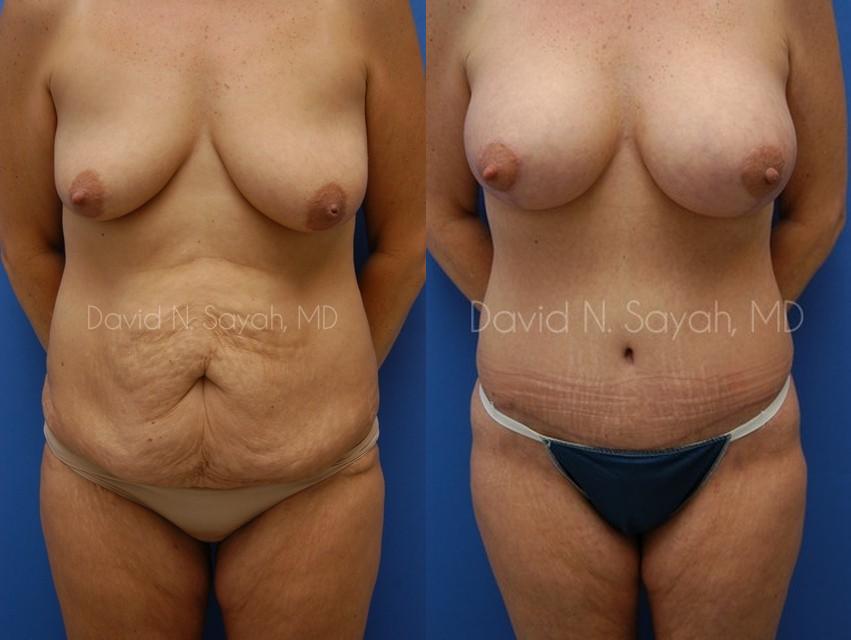 Mommy Makeover Before and After | Sayah Institute
