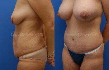 Mommy Makeover Before and After | Sayah Institute