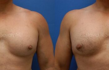 Nipple Revision Before and After | Sayah Institute