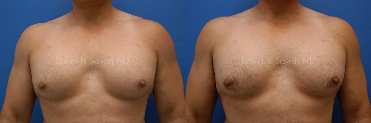 Nipple Revision Before and After | Sayah Institute