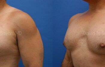 Nipple Revision Before and After | Sayah Institute