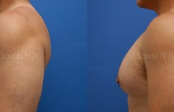 Nipple Revision Before and After | Sayah Institute