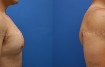 Nipple Revision Before and After | Sayah Institute