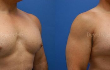 Nipple Revision Before and After | Sayah Institute