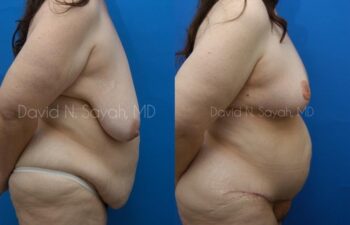 Body Lift Before and After | Sayah Institute