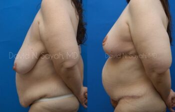 Body Lift Before and After | Sayah Institute