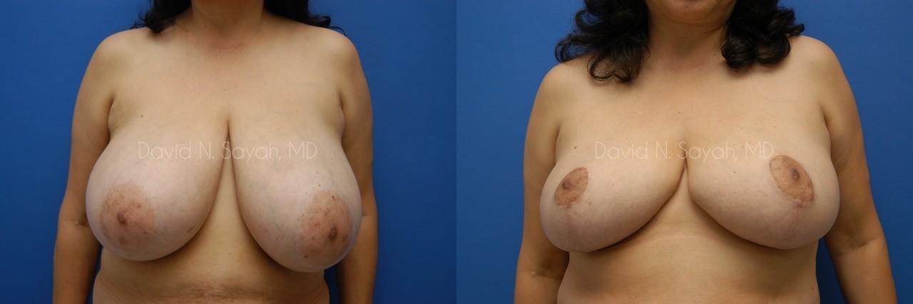 Breast Reduction Before and After | Sayah Institute