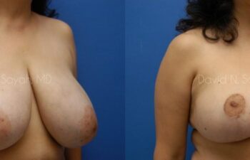 Breast Reduction Before and After | Sayah Institute