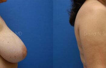Breast Reduction Before and After | Sayah Institute