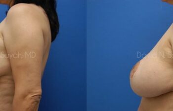 Breast Reduction Before and After | Sayah Institute