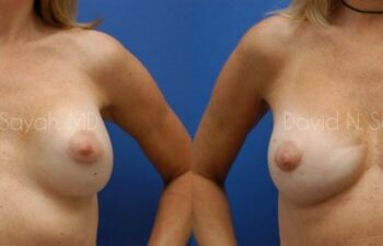 Breast Implant Revision Before and After | Sayah Institute