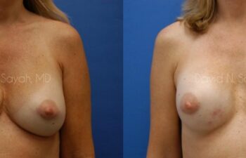 Breast Implant Revision Before and After | Sayah Institute