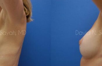 Breast Implant Revision Before and After | Sayah Institute
