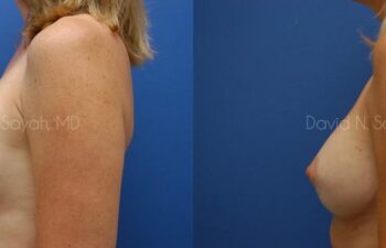 Breast Implant Revision Before and After | Sayah Institute