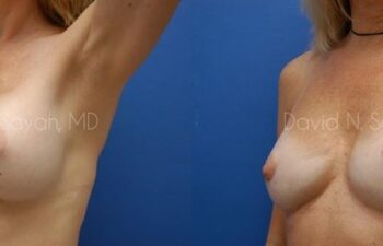 Breast Implant Revision Before and After | Sayah Institute
