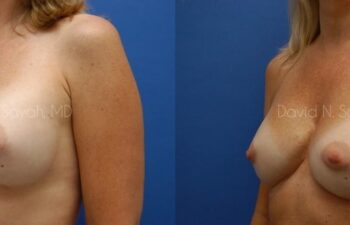 Breast Implant Revision Before and After | Sayah Institute